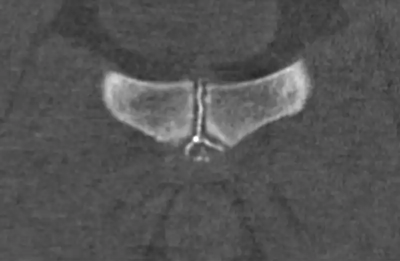 Symphysography secondary cleft sign